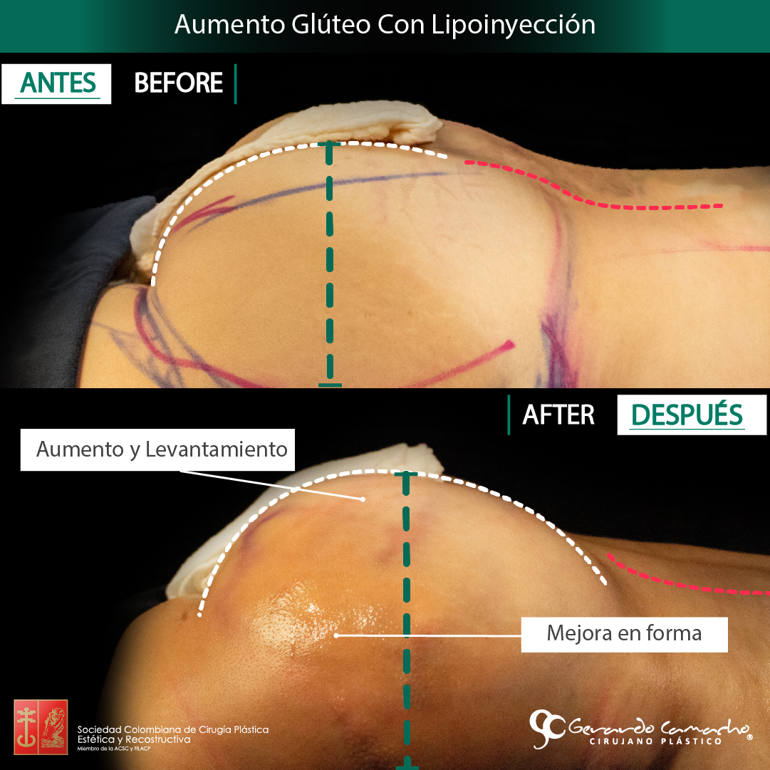 Transformación estética con gluteoplastia en Bogotá